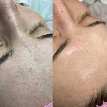 Карбоновый пилинг возвращает свежесть и молодость.
                    Мастер перманентного макияжа Людмила Черноморск