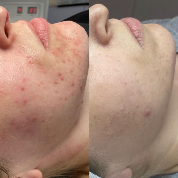 Карбоновый пилинг возвращает свежесть и молодость.
                    Мастер перманентного макияжа Людмила Черноморск