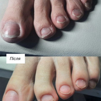 Гігієнічний педикюр