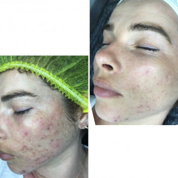 Плазмове чищення шкіри
                    Косметолог  Киев