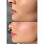 Акція на чистку обличчя Косметолог-естетист  Івано-Франківськ