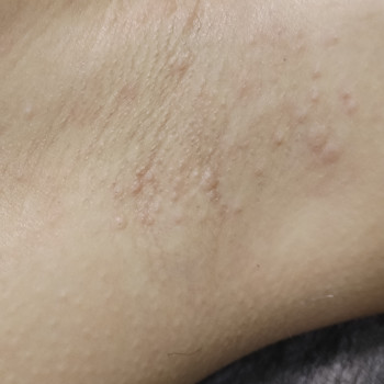 После процедуры, фото - мастер депиляции Аня Мельничук