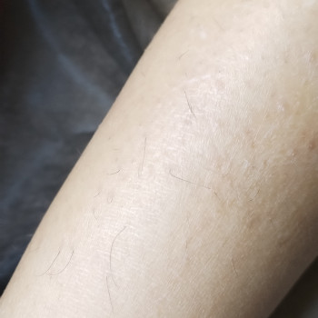 До, фото - мастер депиляции Аня Мельничук