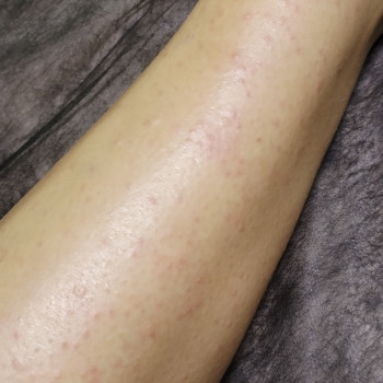 После, фото - мастер депиляции Аня Мельничук