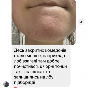 Плазмове чищення шкіри
                    Косметолог  Киев