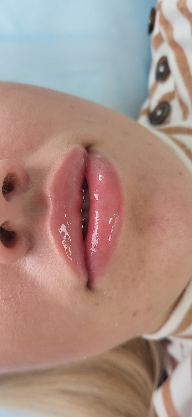 Філлер Сарденія, фото - Косметолог-эстетист Ольга Яхина