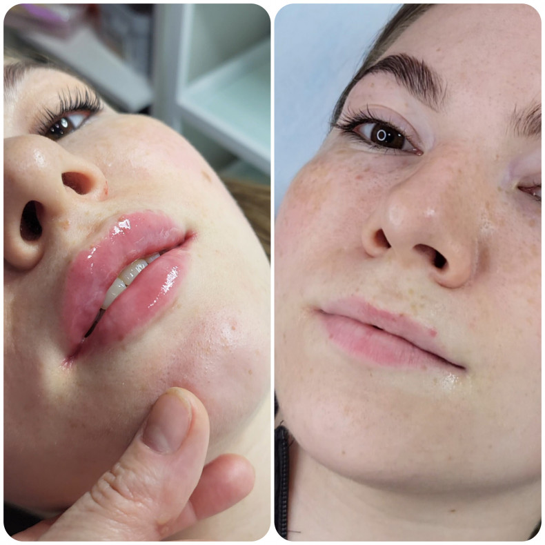 Філлер Richesse 1мл, фото - Косметолог-эстетист Ольга Яхина