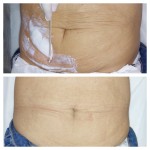 Мікроголковий RF ліфтинг обличчя Врач-косметолог  Киев