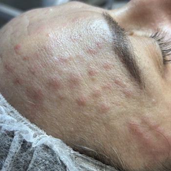 Мезотерапія обличчя
                    Косметолог-эстетист Ольга Хмельницкий