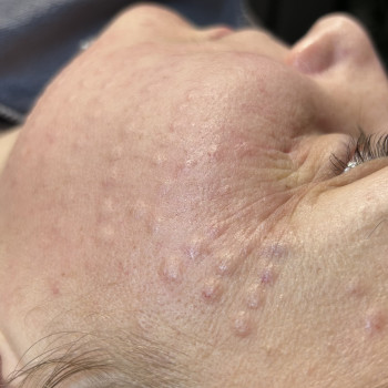 Мезотерапія обличчя
                    Косметолог-эстетист Ольга Хмельницкий