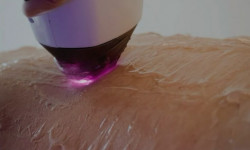 Лазерна епіляція Косметологический центр  Стрый