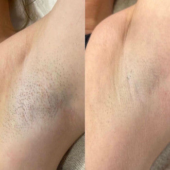 Лазерна епіляція
                    Косметологический центр  Стрый