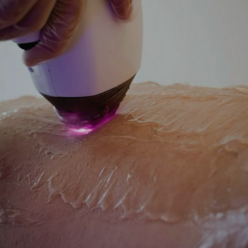 Лазерна епіляція