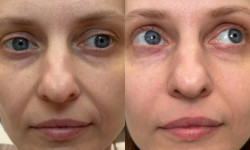 Біоревіталізація -зволоження шкіри обличчя та тіла Косметолог Елена Одесса