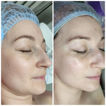 До та після одна процедура і Ваше обличчя сяє, підтягується підборіддя.