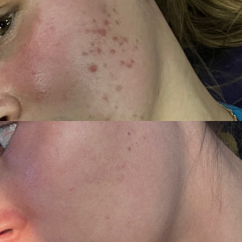 Робота з рубцями та постакне