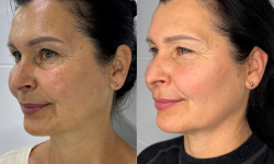 Rf-ліфтинг Врач-косметолог Ксенія Ужгород