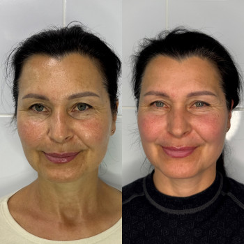 Мікроголковий rf-ліфтинг Ужгород