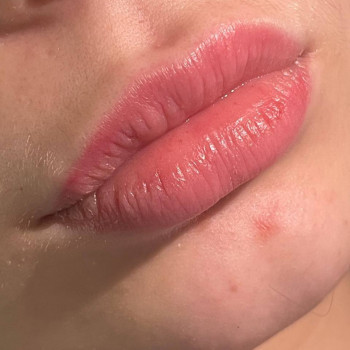 Губки на 6-ий день після процедури