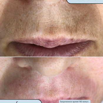 Електроепіляція верхної губи