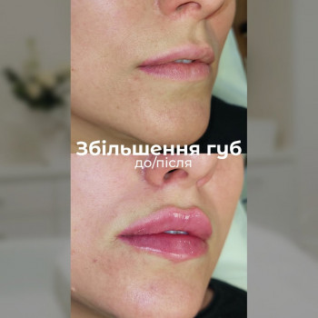 контурная пластика губ, губы, губы банты, инъекции красоты