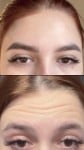 -15% FULL FACE BOTOX ( корекція зморшок все обличчя та шия) Косметолог-ін'єкціоніст Kristina Ужгород