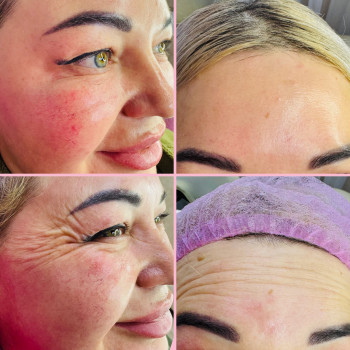 Ботокс обличчя