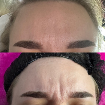 Ботокс міжбрівка