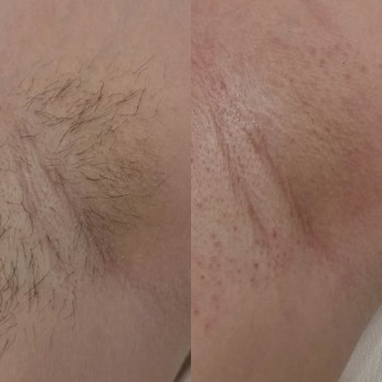 До і Після. Зона пахви