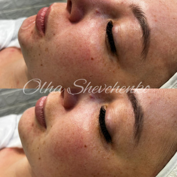 Мікрострумова терапія
                    Косметолог-эстетист  Одесса