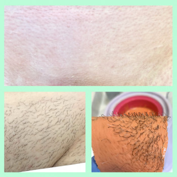 Депіляція воском зони глибокого бікіні