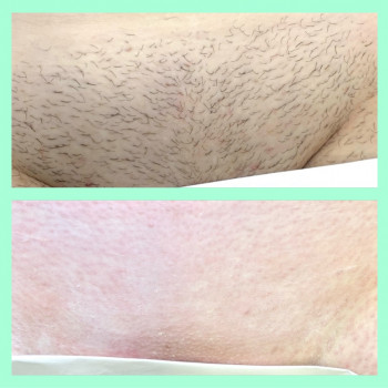 Депіляція воском зони глибокого бікіні