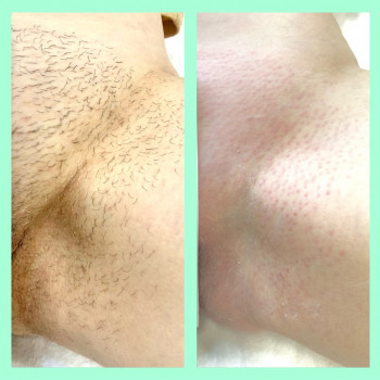 Депіляція воском зони глибокого бікіні