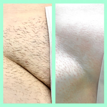 Депіляція воском зони глибокого бікіні