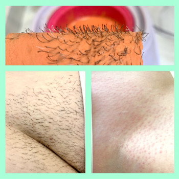 Депіляція воском зони глибокого бікіні