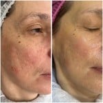 Чистка обличчя ультразвукова Косметолог-инъекционист Наталья Днепр