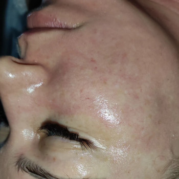 Массаж лица карбокситерапия