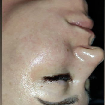 Массаж лица карбокситерапия