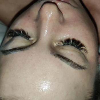 Массаж лица карбокситерапия