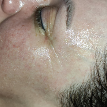 Массаж лица карбокситерапия