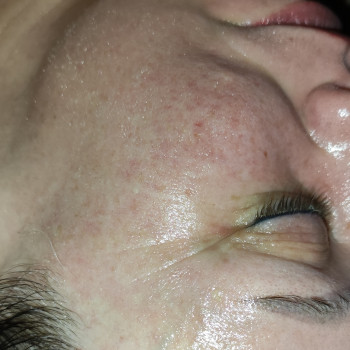 Массаж лица карбокситерапия