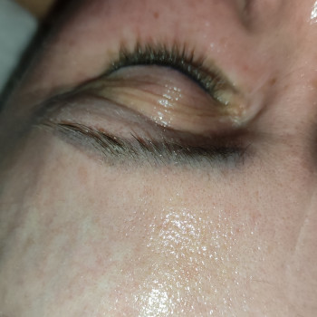 Массаж лица карбокситерапия