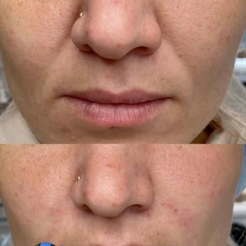 Носогубна складка від 2800