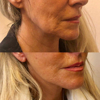 Полімолочна кислота 6000 грн