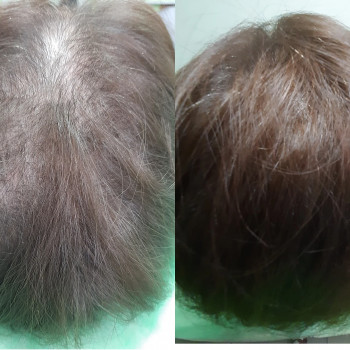 Пілінг
                    Косметолог-естетист  Івано-Франківськ