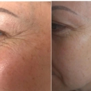 Пілінг
                    Косметолог-естетист  Івано-Франківськ