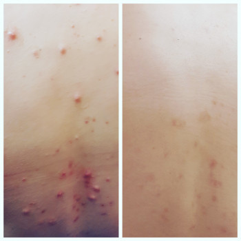 Пілінг
                    Косметолог-естетист  Івано-Франківськ