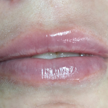 Пілінг
                    Косметолог-естетист  Івано-Франківськ