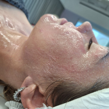 Пілінг
                    Косметолог-эстетист  Ивано-Франковск