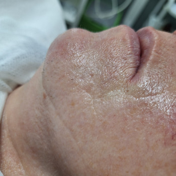 Пілінг
                    Косметолог-эстетист  Ивано-Франковск